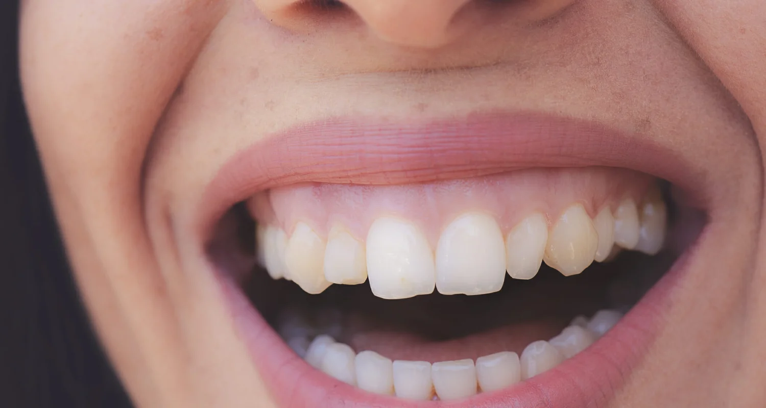 3- Causas de la sonrisa gingival