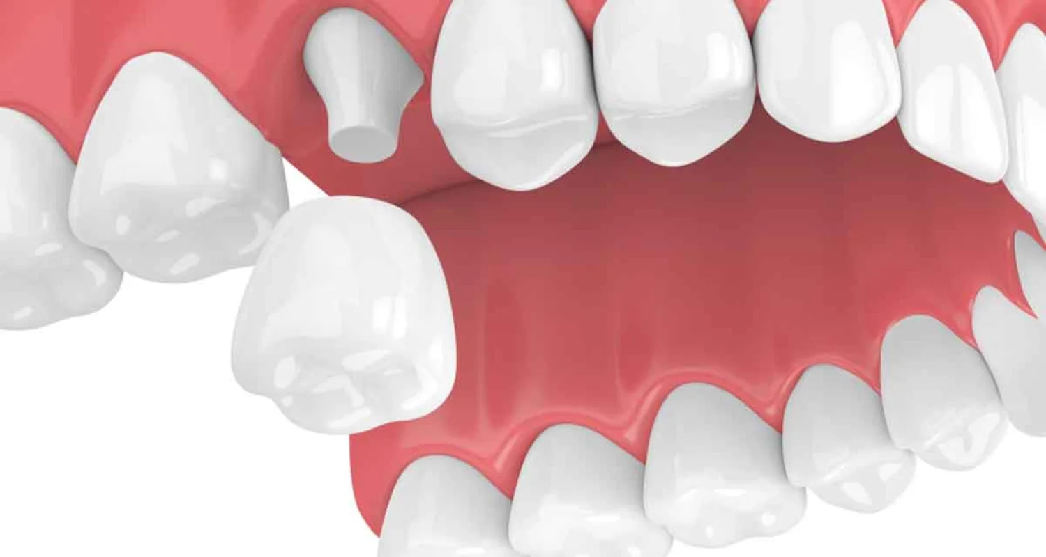 3 - Definition of crowns - difference between a veneer and a crown