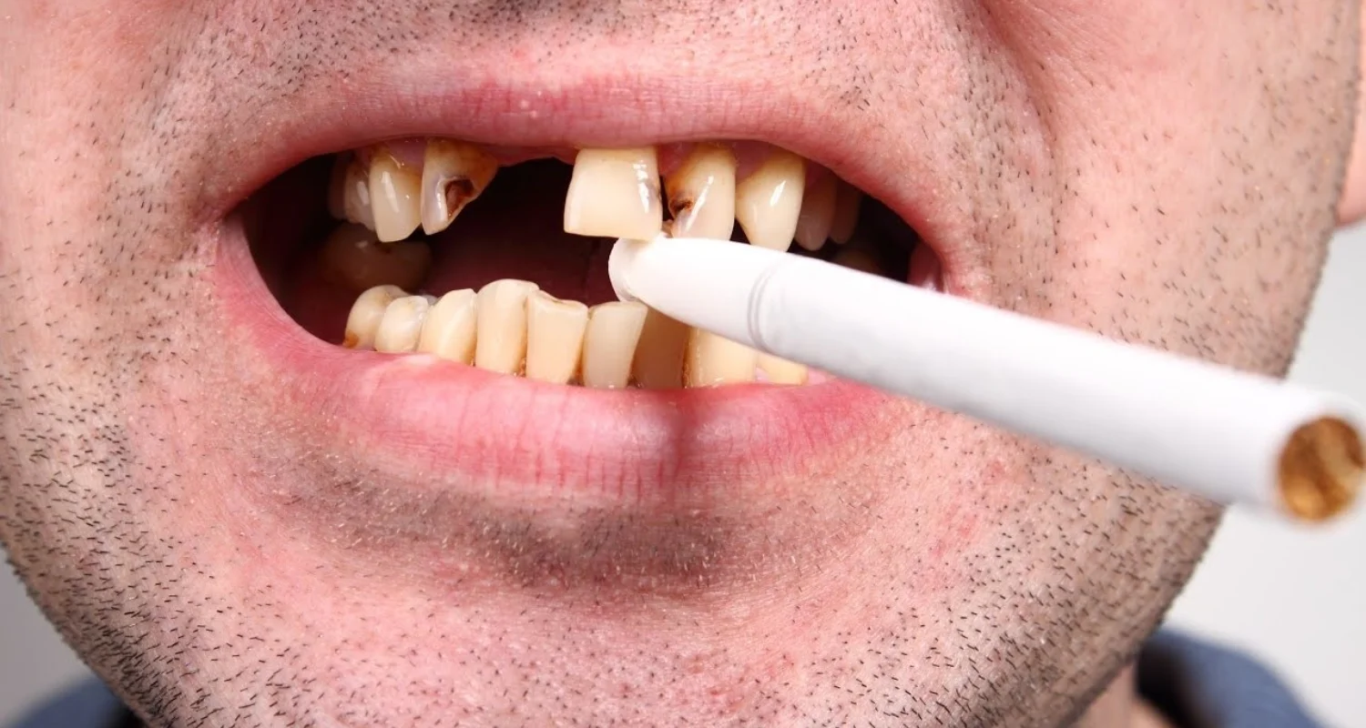 3 - Efectos de las manchas de tabaco en los dientes