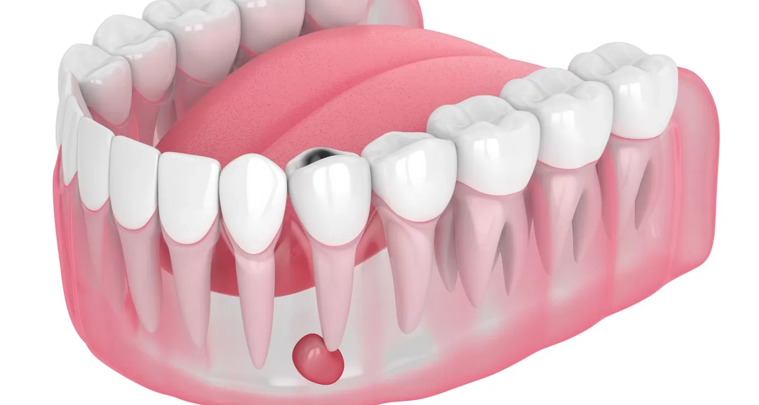 3 - Tooth abscess - throbbing tooth pain