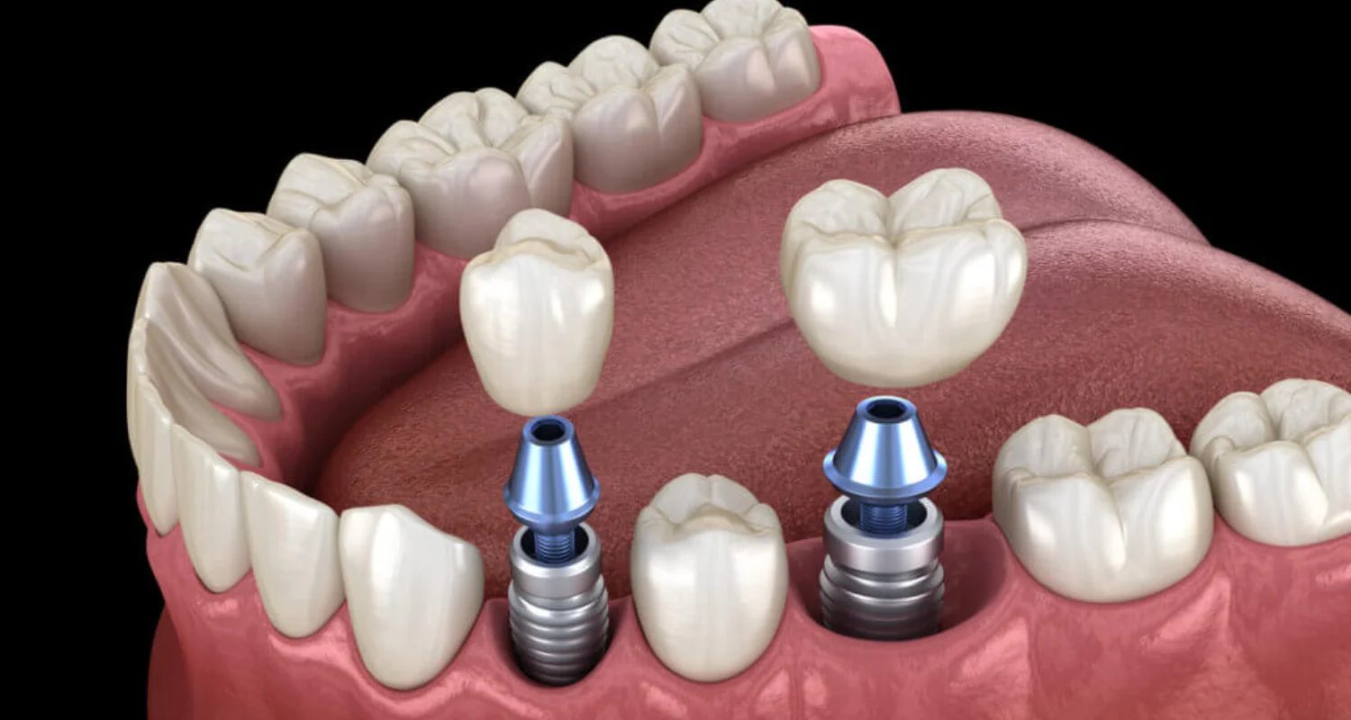 3 - What is Peri-implantitis_ How common and what puts you at risk