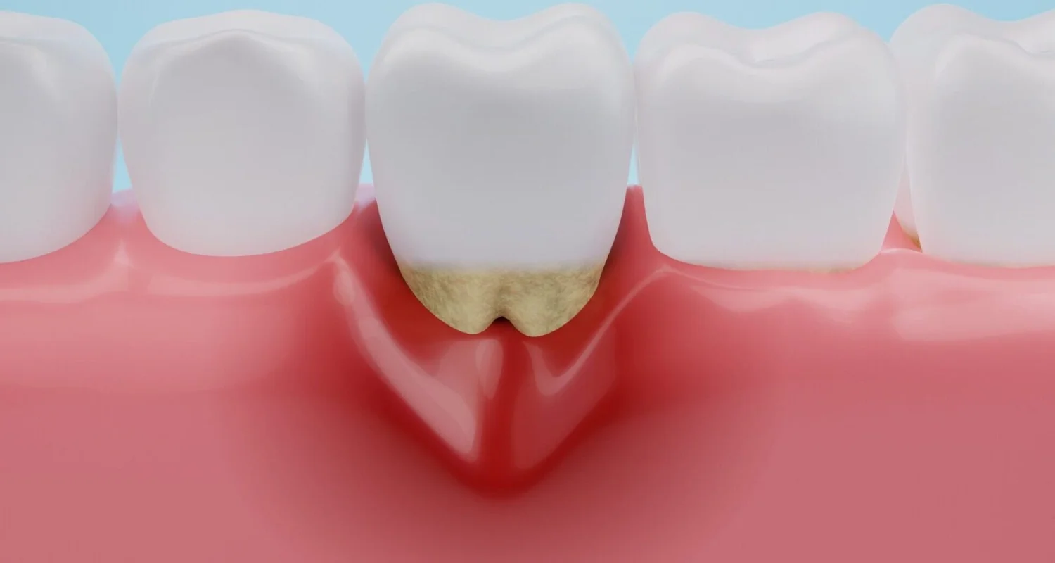 4 - Enfermedad periodontal no controlada - qué es la periimplantitis