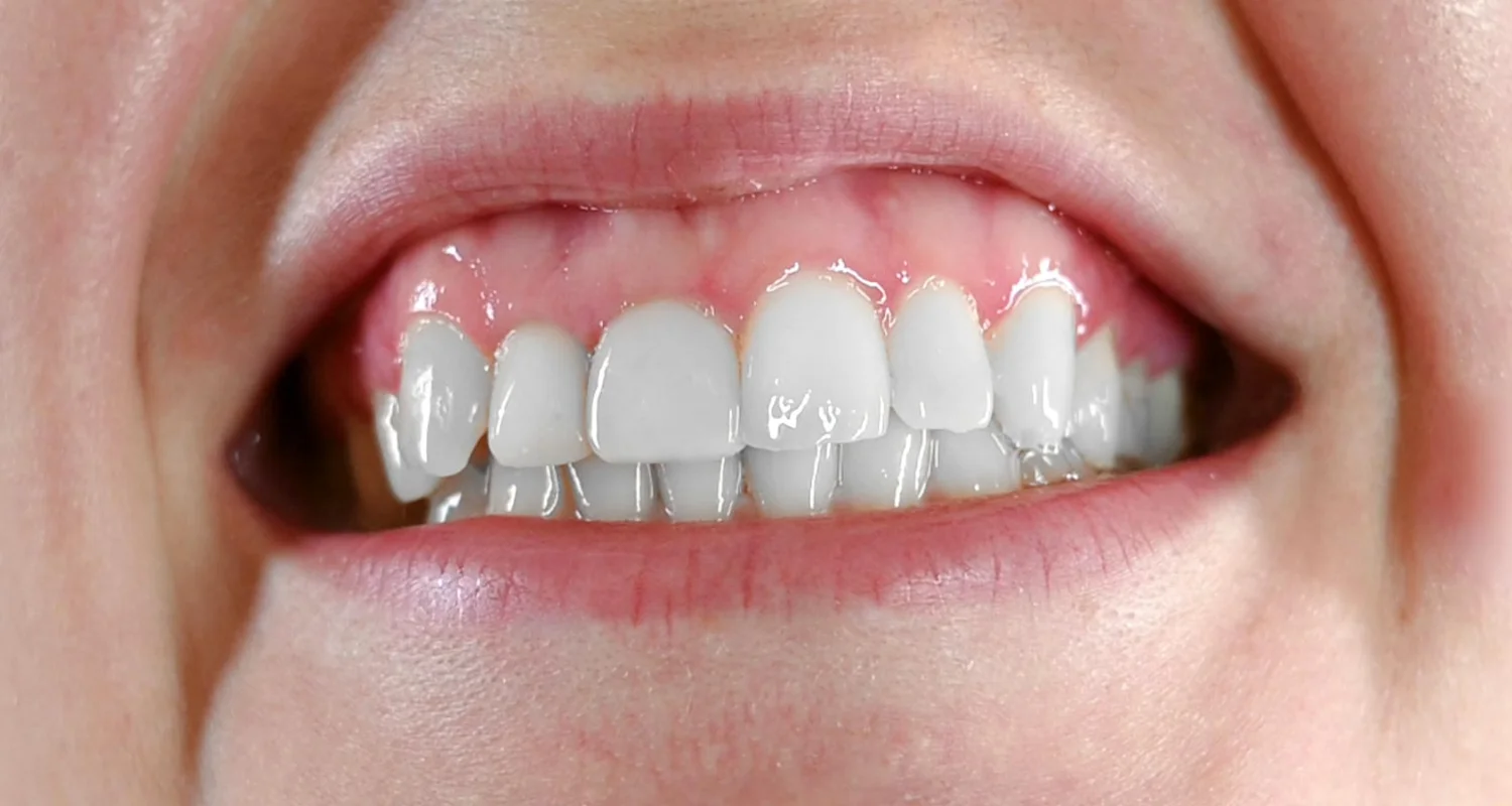 4 - How to tell if you have a gummy smile