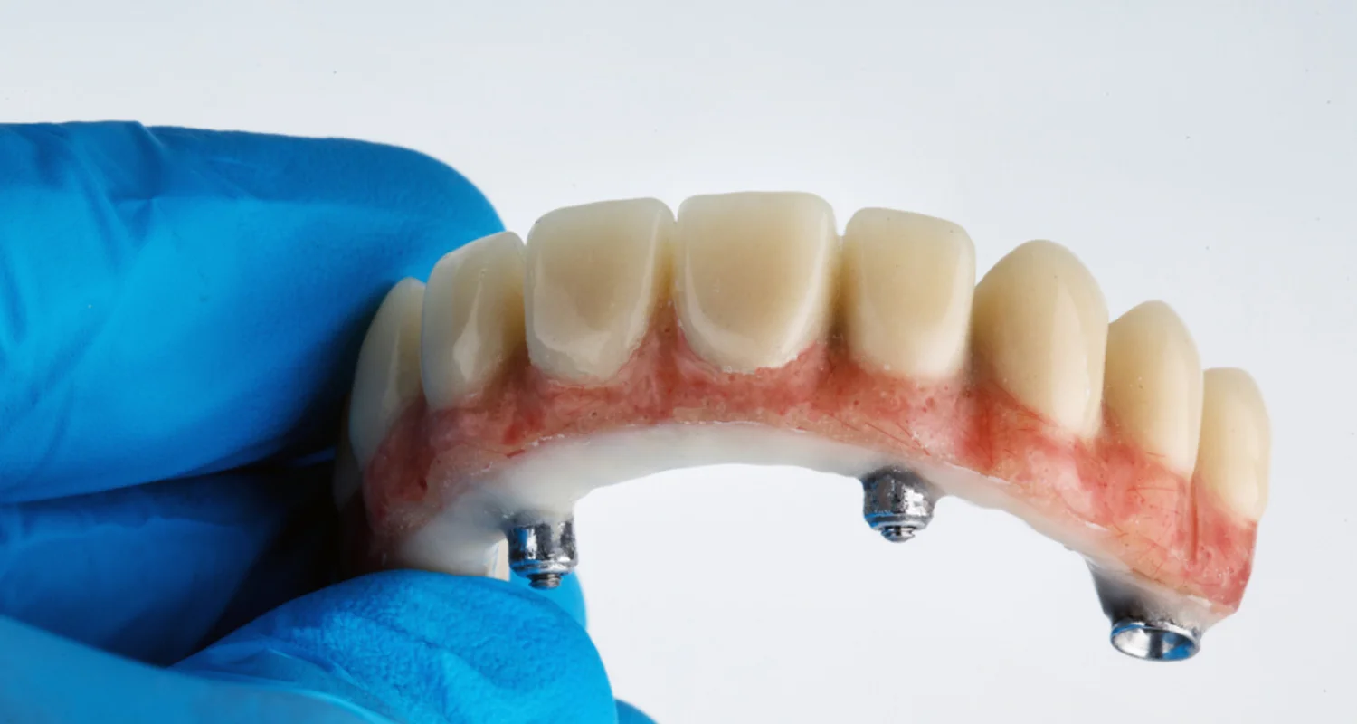 4 - Miniimplante dental_ lo bueno y lo malo de esta alternativa