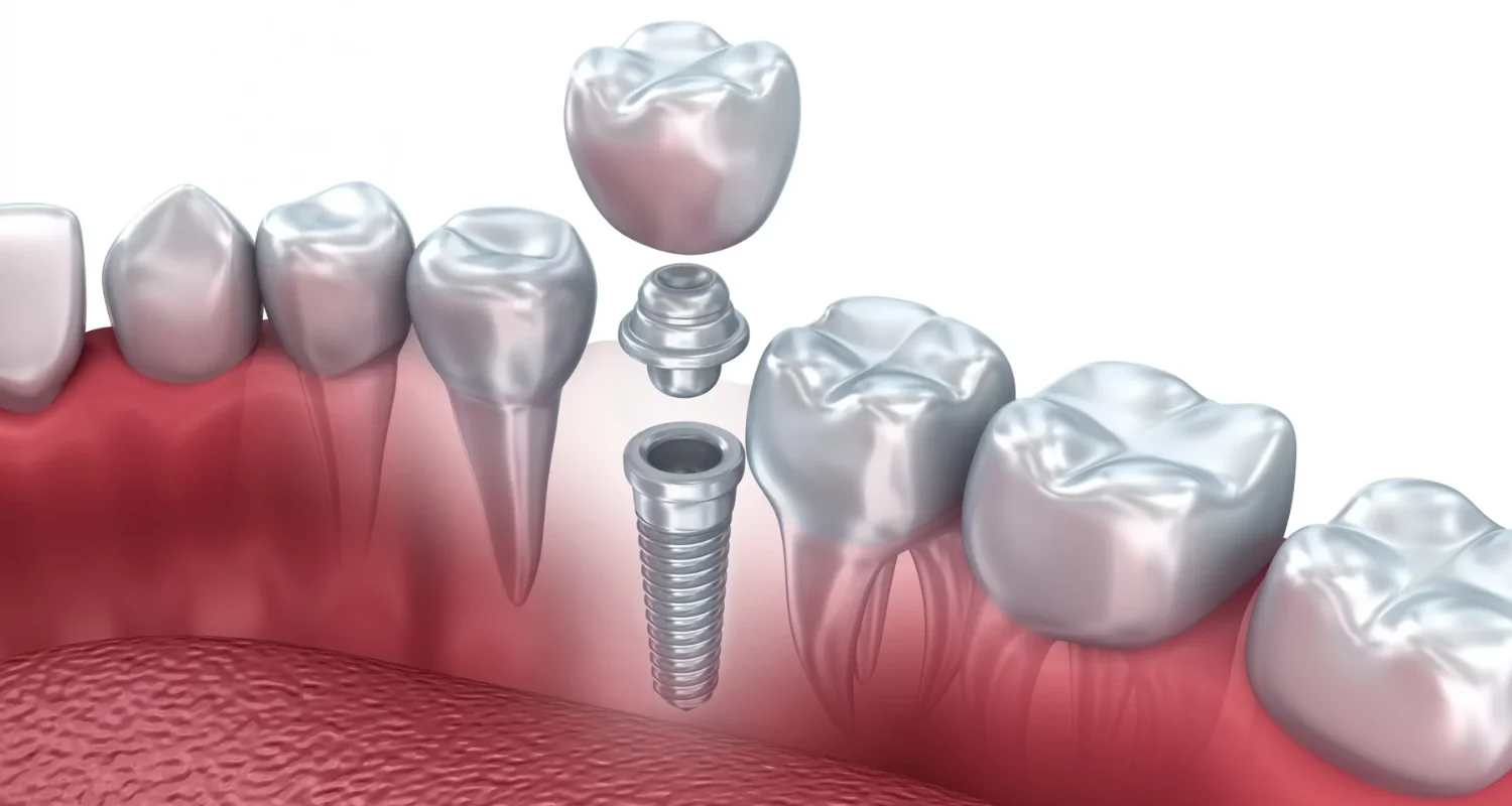 4 - Natural look and function - What are mini dental implants