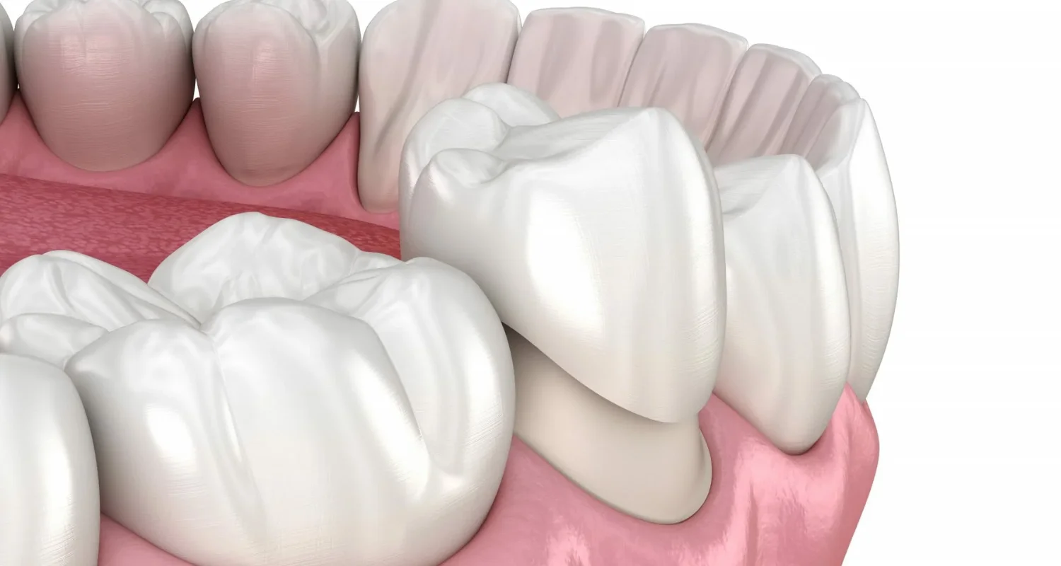 4 - Paso a paso para la colocación de carillas y coronas - diferencia entre carilla y corona dental