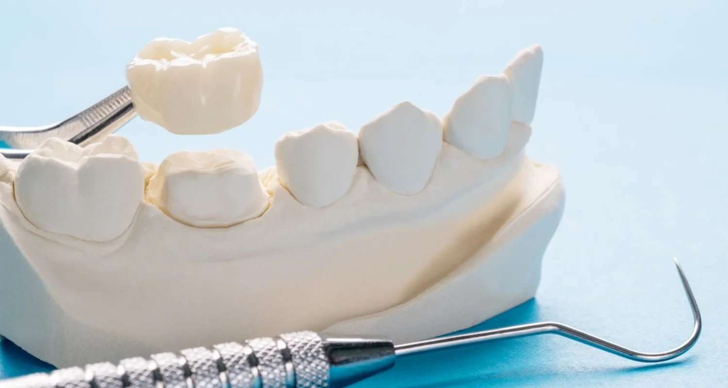 4 - Step-by-step guide for placing veneers and crowns - difference between a veneer and a crown