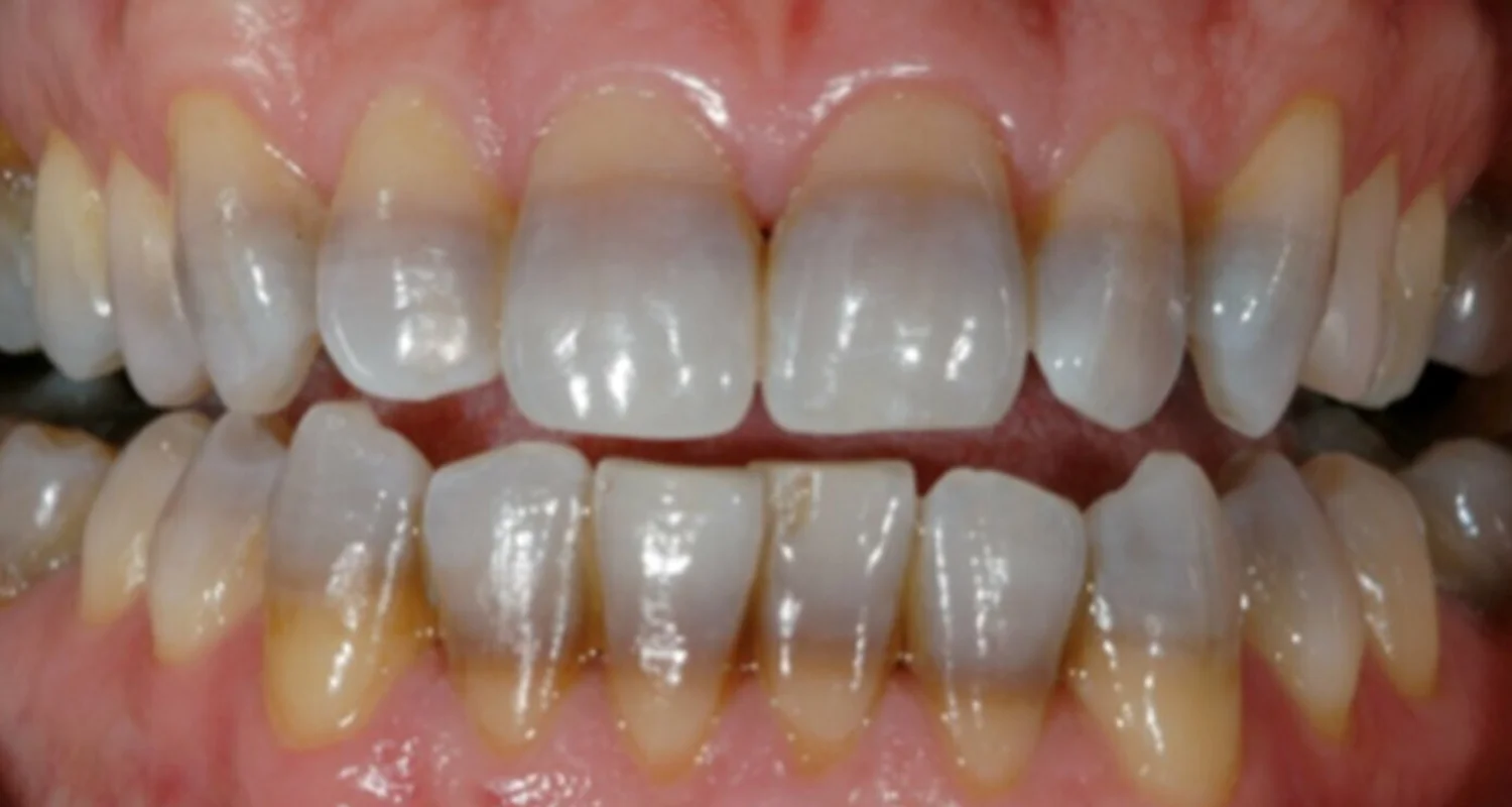 4 - What happens if smoking teeth stains are not removed