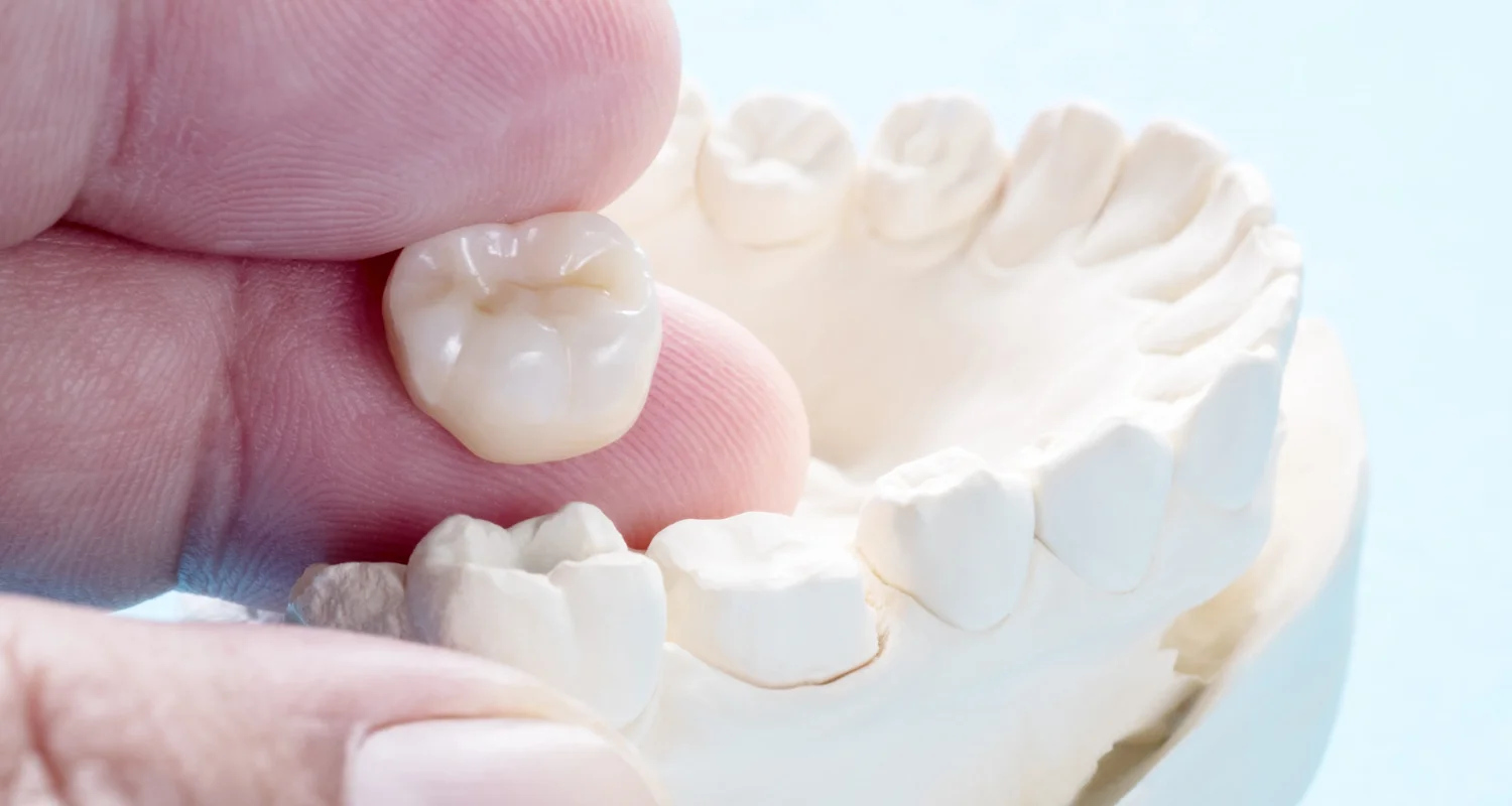 5 - ¿Cómo se realiza una corona_ - diferencia entre carilla y corona dental