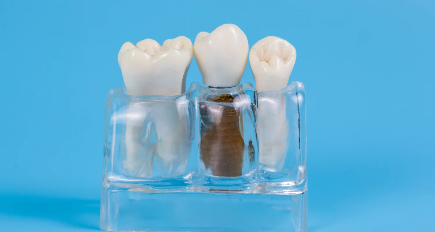 5 - Miniimplantes vs. implantes tradicionales - miniimplante dental