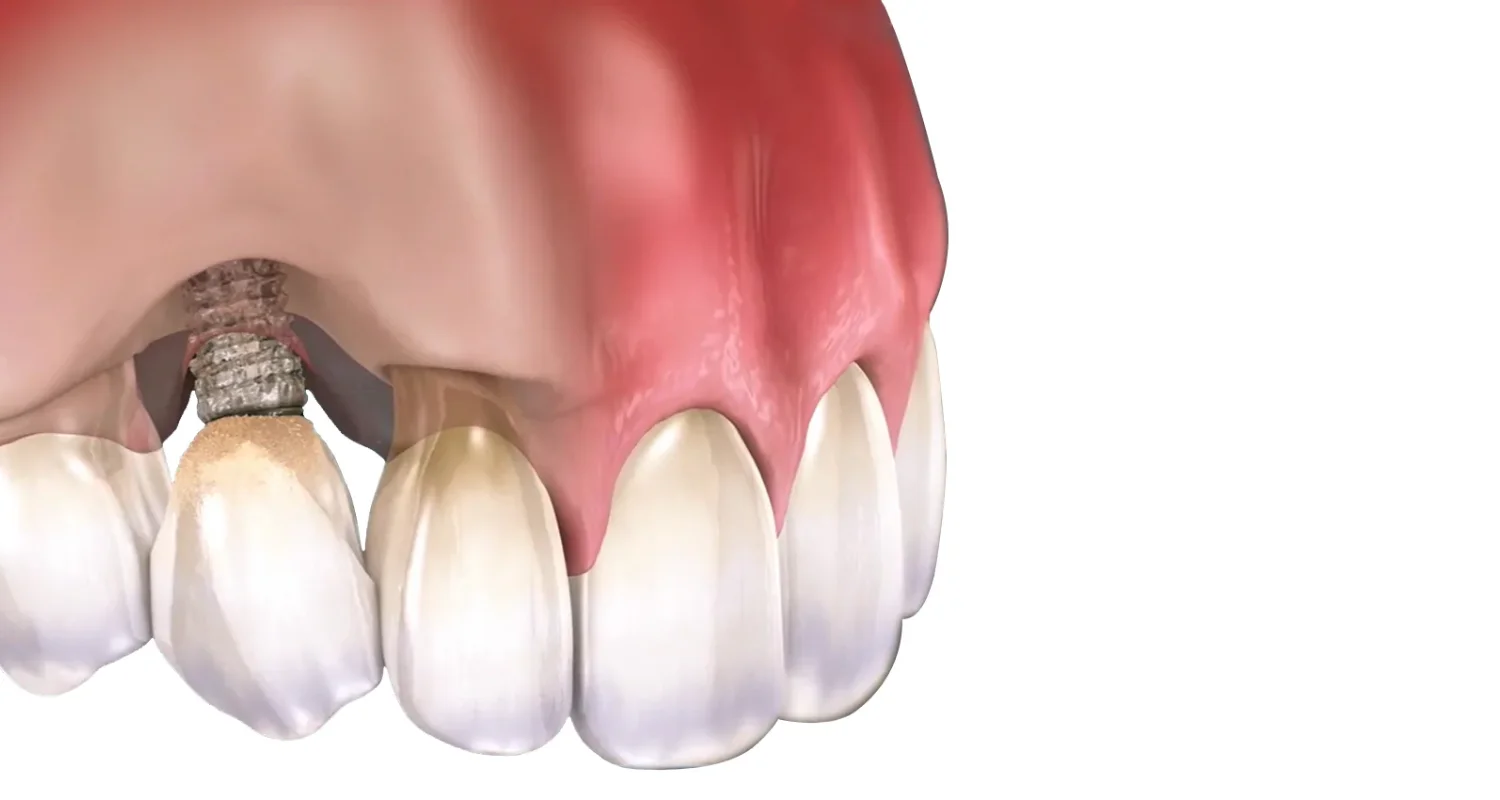 5 - Periimplantitis moderada - qué es la periimplantitis