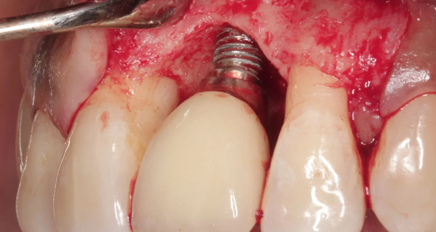 5 - Surgical treatment (for moderate to severe cases) - what is peri-implantitis