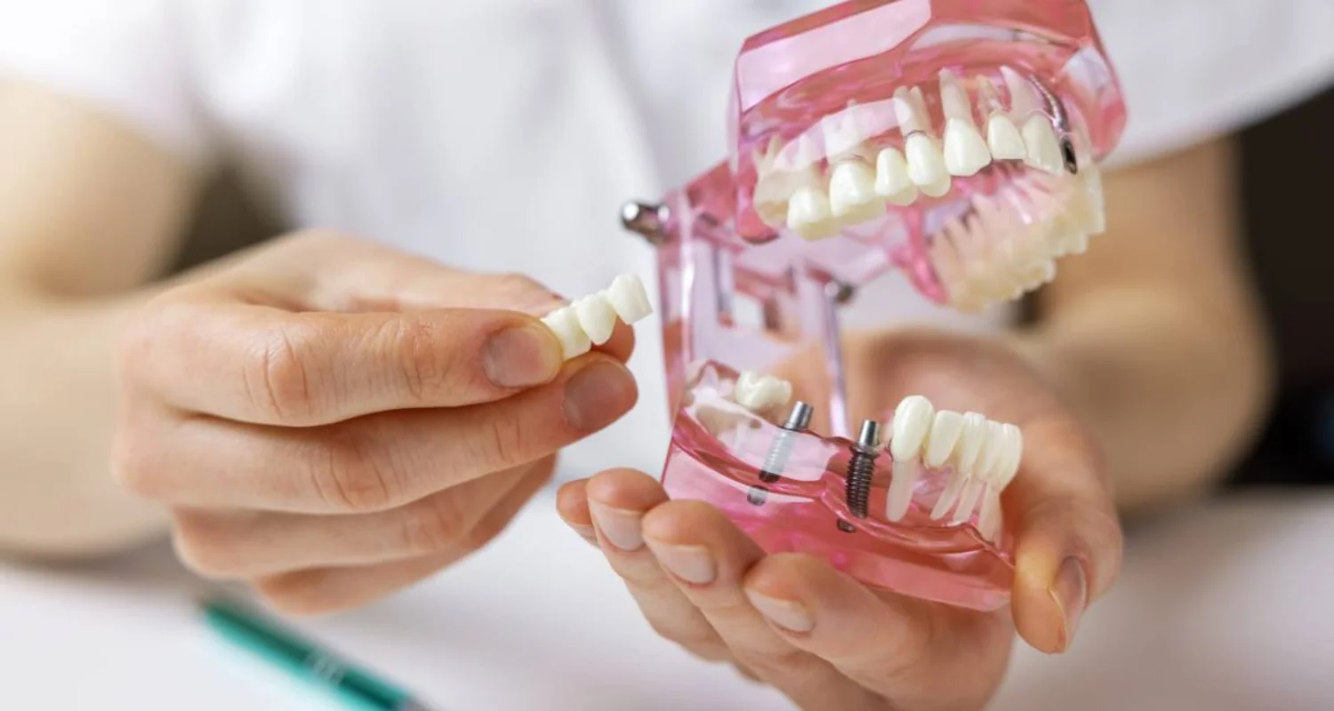 6 - Consejos para el éxito a largo plazo de tu implante dental - Cómo cuidar un implante dental