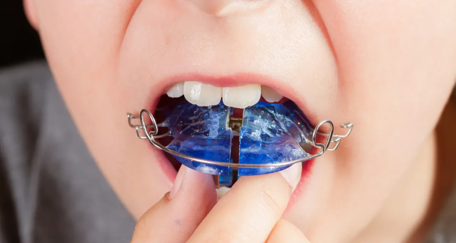 6 - How interceptive orthodontic treatment works