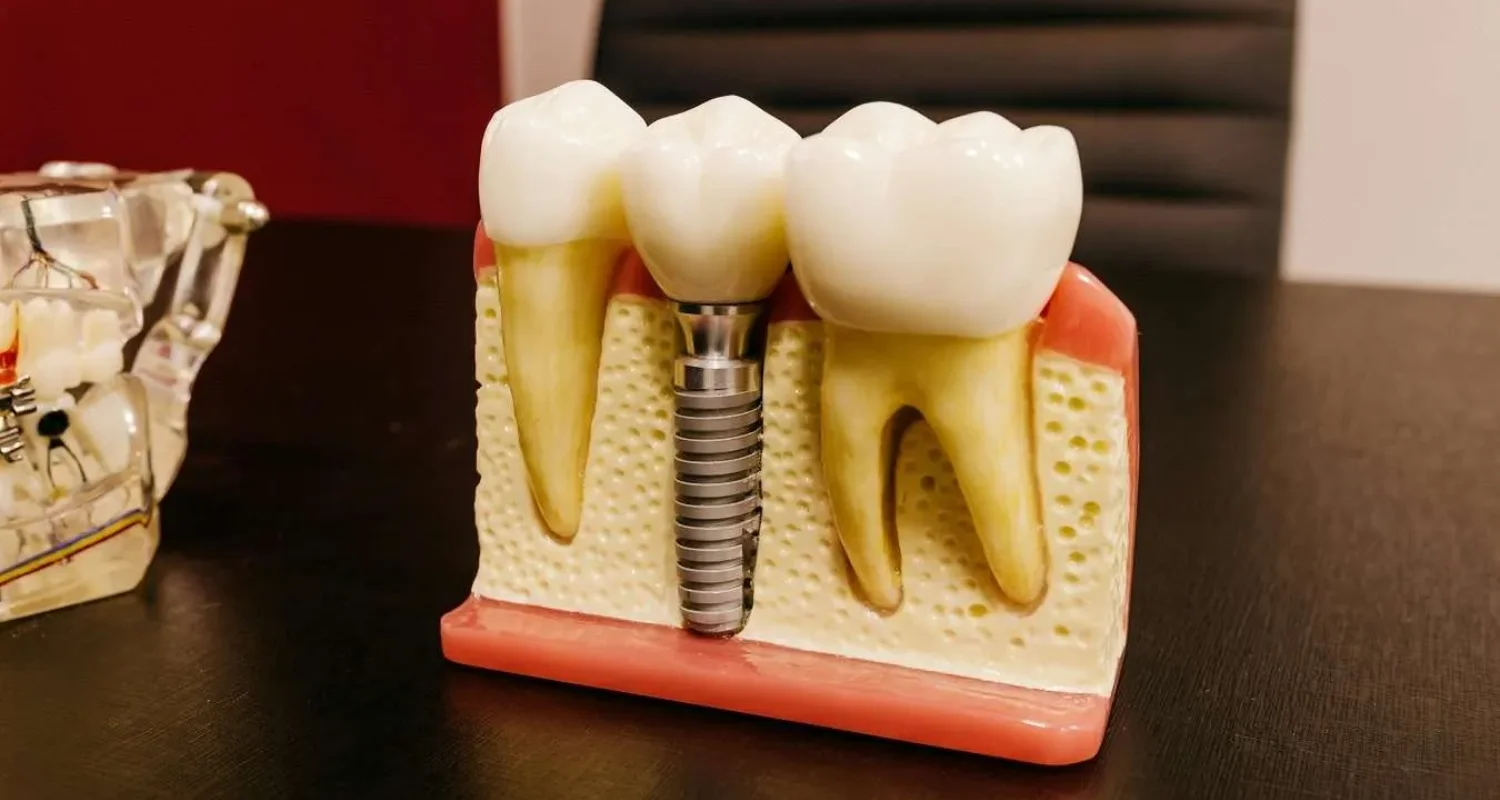 6 - How long do mini dental implants last - What are mini dental implants