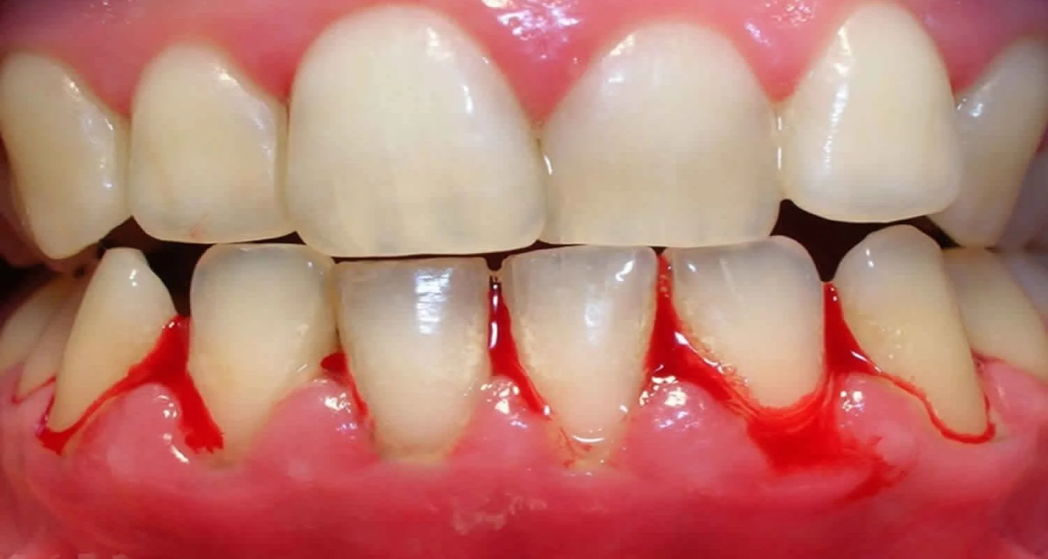 6 - Implicaciones de no tratar la sonrisa gingival