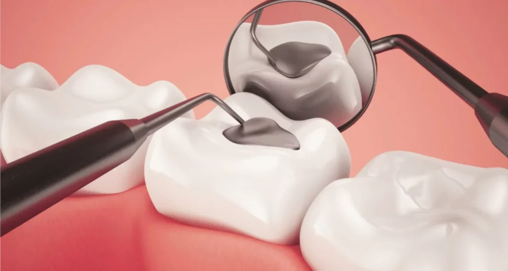 1 - ¿Duele un empaste dental por caries_ Todo sobre el proceso