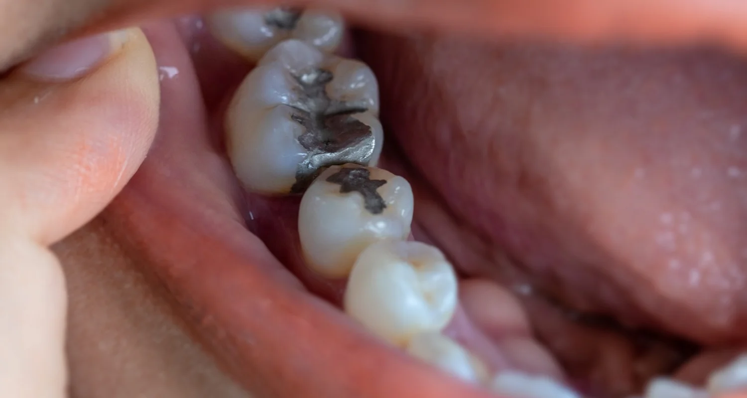 2 - What are dental fillings, and why are they important_ - Do Cavity Fillings Hurt