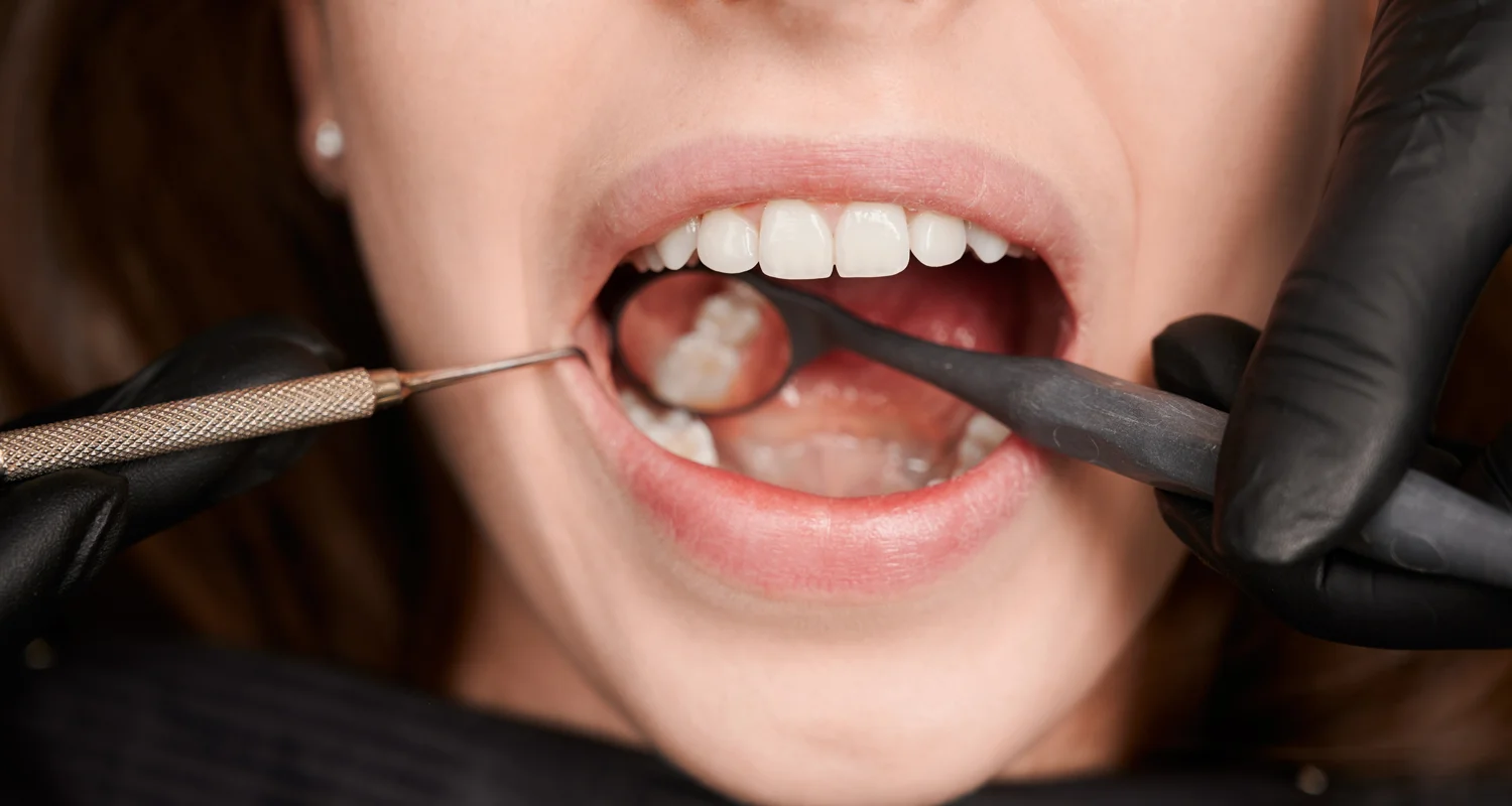 3 - ¿Duele un empaste dental por caries