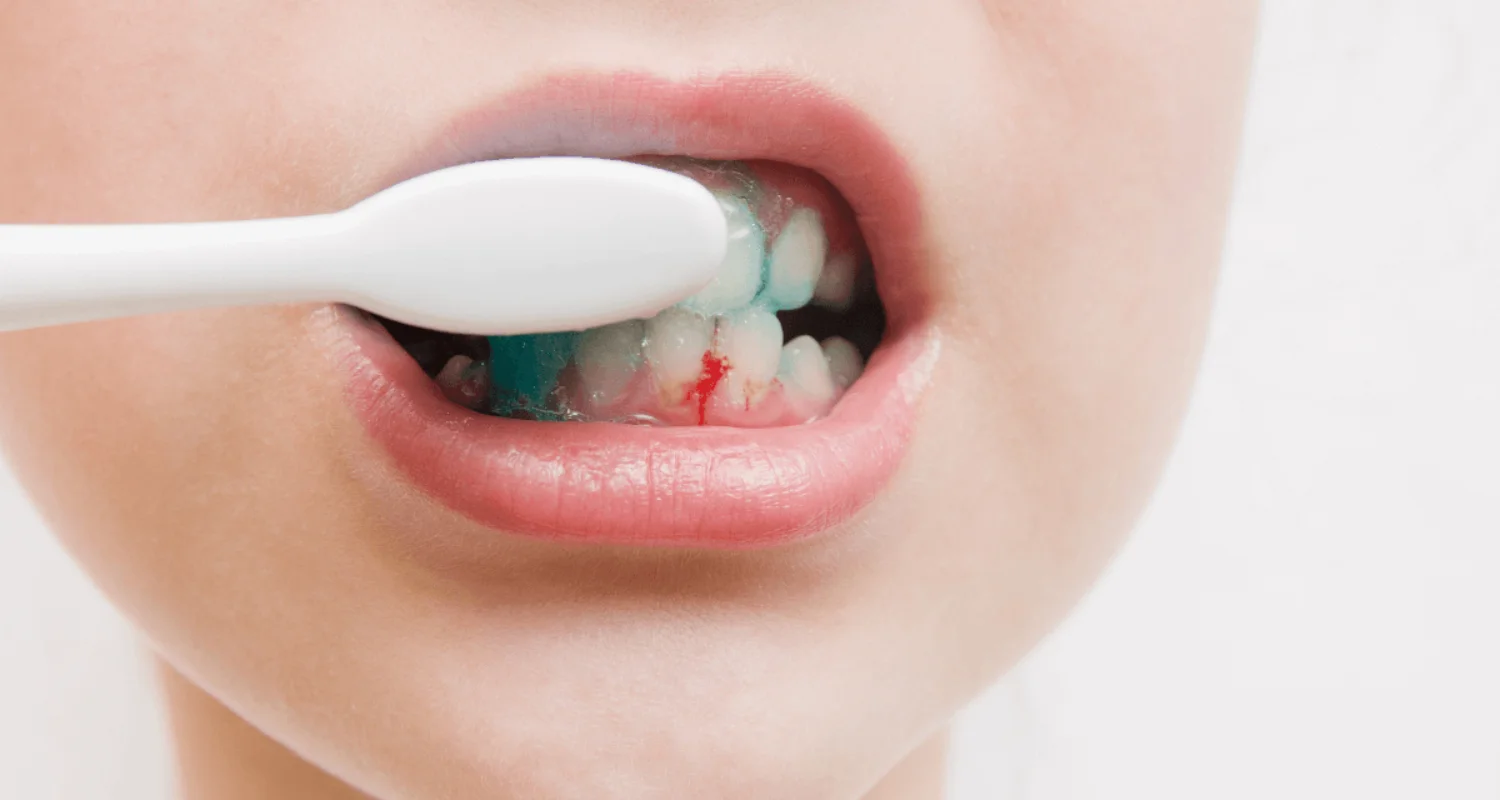 3 - Are you overbrushing your teeth_ Signs and risks - overbrushing teeth