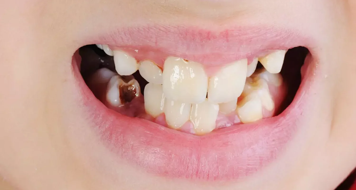 4 - Caries dental - El chocolate daña los dientes