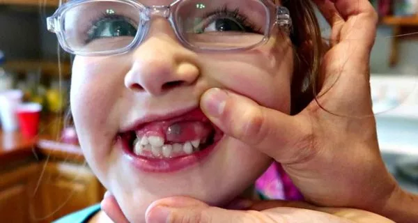 Purple Gums: What They Mean and How to Treat Them 13 Purple Gums: What They Mean and How to Treat Them