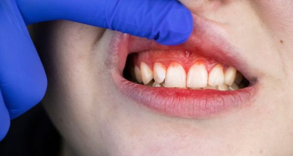 Purple Gums: What They Mean and How to Treat Them