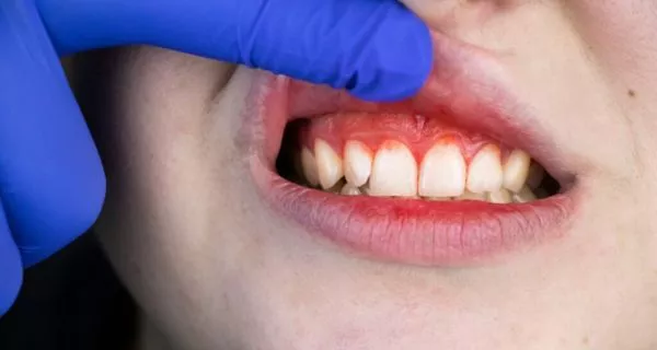 Purple Gums: What They Mean and How to Treat Them 12 Purple Gums: What They Mean and How to Treat Them