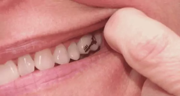 ¿Are tooth tattoos permanent?