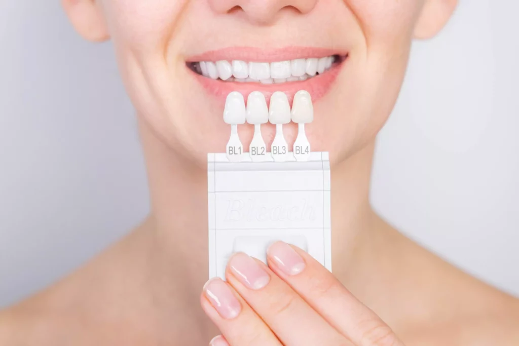 How Long Do Veneers Last? Lifespan and Care Tips