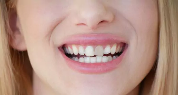 Ideal candidates for veneers