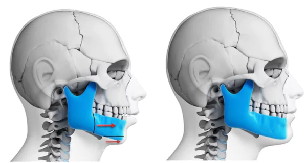 Crossbite teeth: what it is and how to fix it