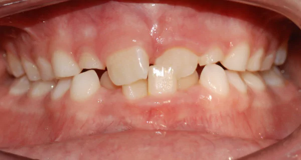 Crossbite teeth: what it is and how to fix it