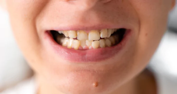 Crossbite teeth: what it is and how to fix it