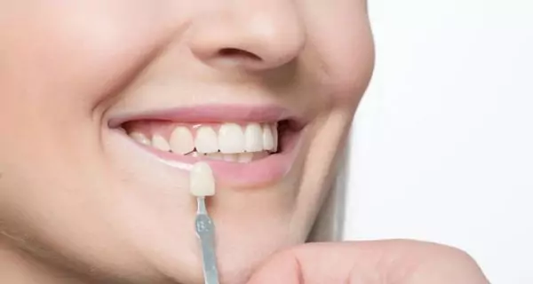 What are veneers?