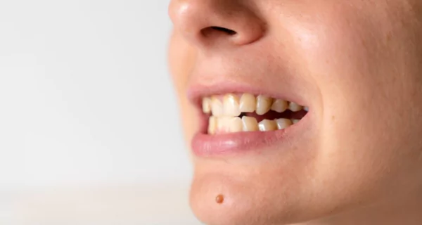 Crossbite teeth: what it is and how to fix it