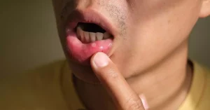 Does Lupus Affect Your Teeth