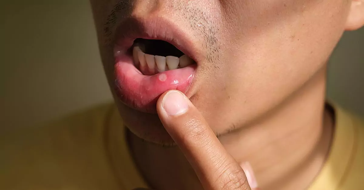 Does Lupus Affect Your Teeth