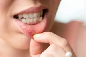 Pimple Inside Lip