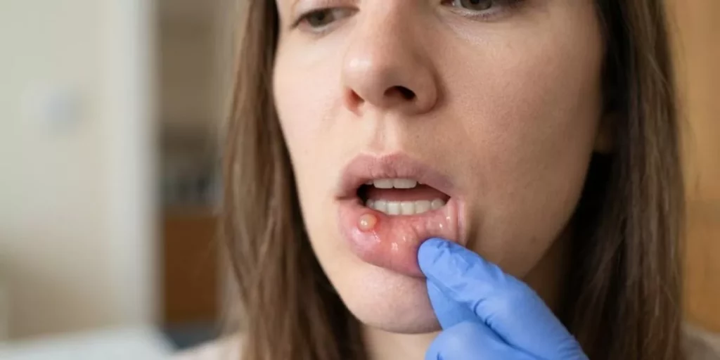 Grano dentro del labio: posibles causas y cómo eliminarlo