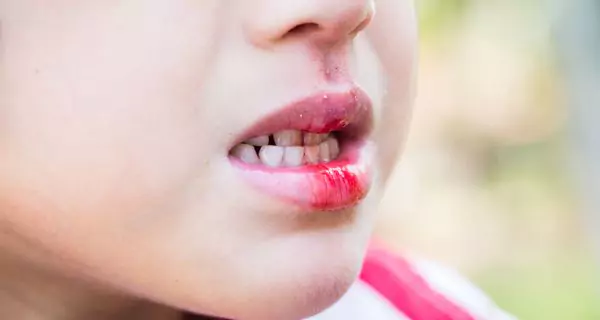 Tooth fractures