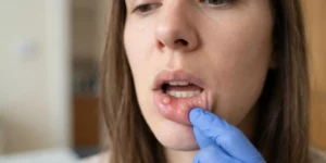 What Causes a Pimple Inside Lip And How To Treat It?