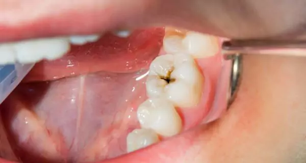 2. Higher risk of cavities