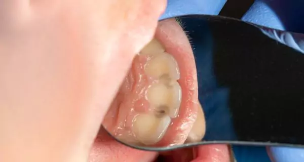 2. Mayor riesgo de caries
