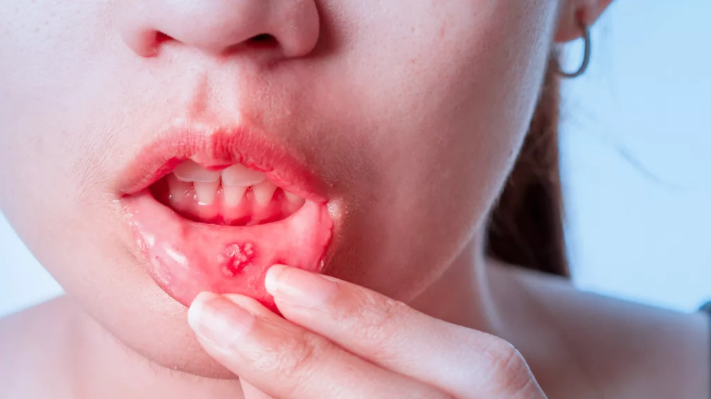 What You Need to Know About Oral Ulcers in Lupus