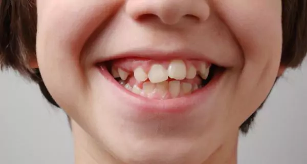 ¿Cómo afecta la salud bucal al desarrollo del habla?