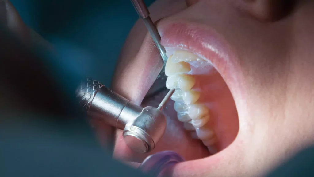 ¿Cómo saber si necesito una endodoncia?
