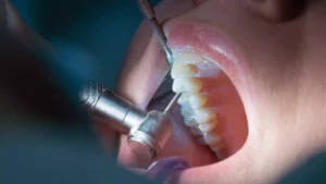 ¿Cómo saber si necesito una endodoncia?