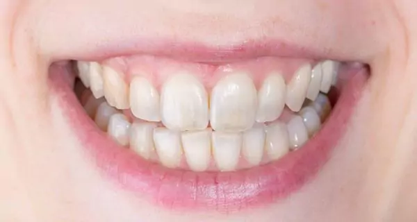 Fortaleza del esmalte y la dentina