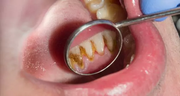 Helps prevent plaque buildup